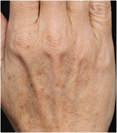 Womans hand before treatment with Fraxel fractional skin resurfacing laser