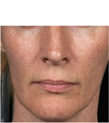 Her face after one treatment with Fraxel fractional skin resurfacing laser