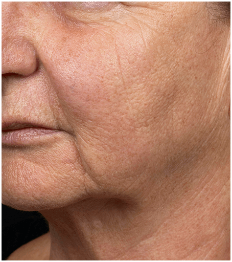 Her face ter one treatment with Fraxel fractional skin resurfacing laser