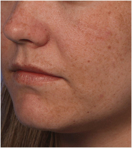 Womans face before treatment with Fraxel fractional skin resurfacing laser