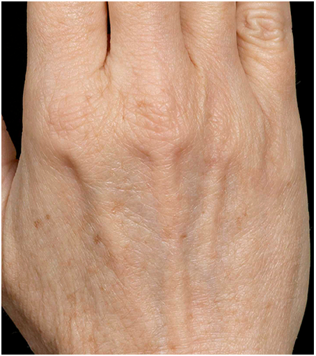 Her hand after one treatment with Fraxel fractional skin resurfacing laser