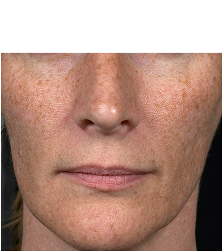 Womans face before treatment with Fraxel fractional skin resurfacing laser